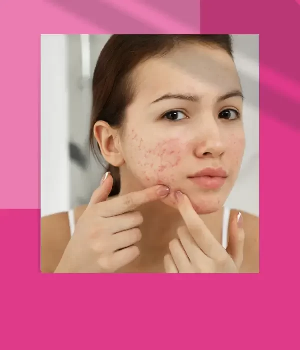 ACNE TREATMENT