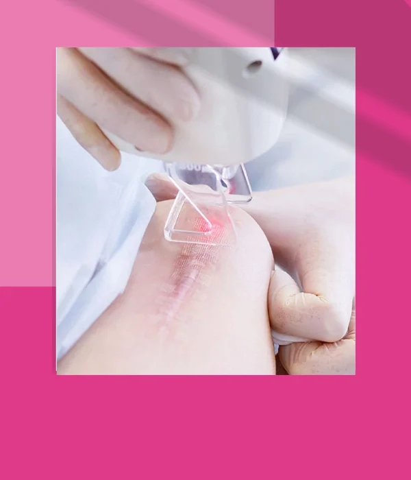 LASER FOR SCARS