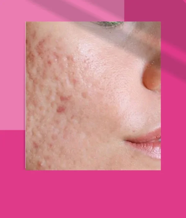 scars treatments slider