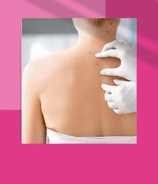 SKIN TAGS - MOLES - WARTS REMOVAL